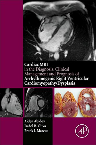 The cardiac MRI in diagnosis, clinical management, and prognosis of arrhythmogenic right ventricular cardiomyopathy/dysplasia