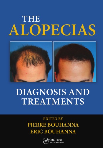Alopecias : diagnosis and treatments