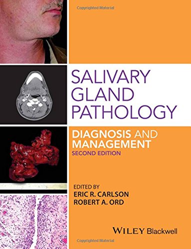 Salivary gland pathology : diagnosis and management