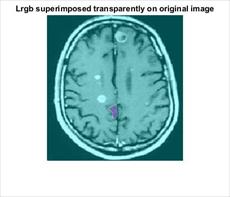دانلود برنامه تشخیص تومور مغزی در تصاویر (ام آر آی) MRI در نرم افزار متلب