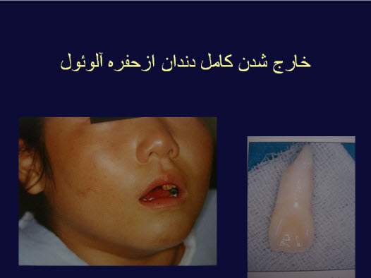 پاورپوینت خارج شدن کامل دندان ازحفره آلوئول