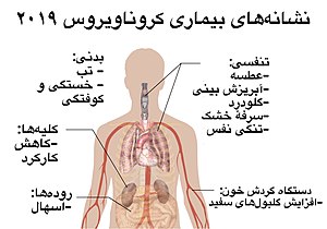 پاورپوینت کامل و جامع با عنوان تشخیص بیماری COVID-19 یا کووید-19 یا کرونا ویروس 2019 در 16 اسلاید