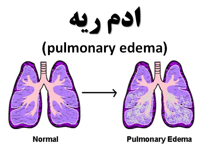 دانلود پاورپوینت ادم ریه(pulmonary edema)