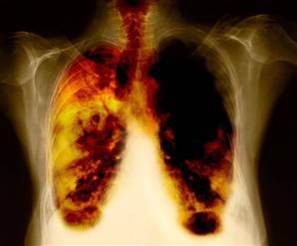 دانلود پاورپوینت مطالعه کنترلی-موردی سرطان ریه در چهار معدن قلع درکشور چین