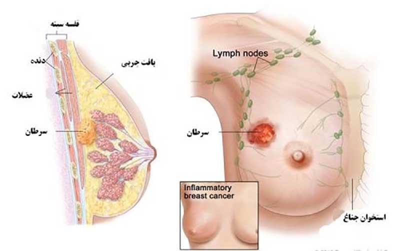 دانلود پاورپوینت سرطان پستان
