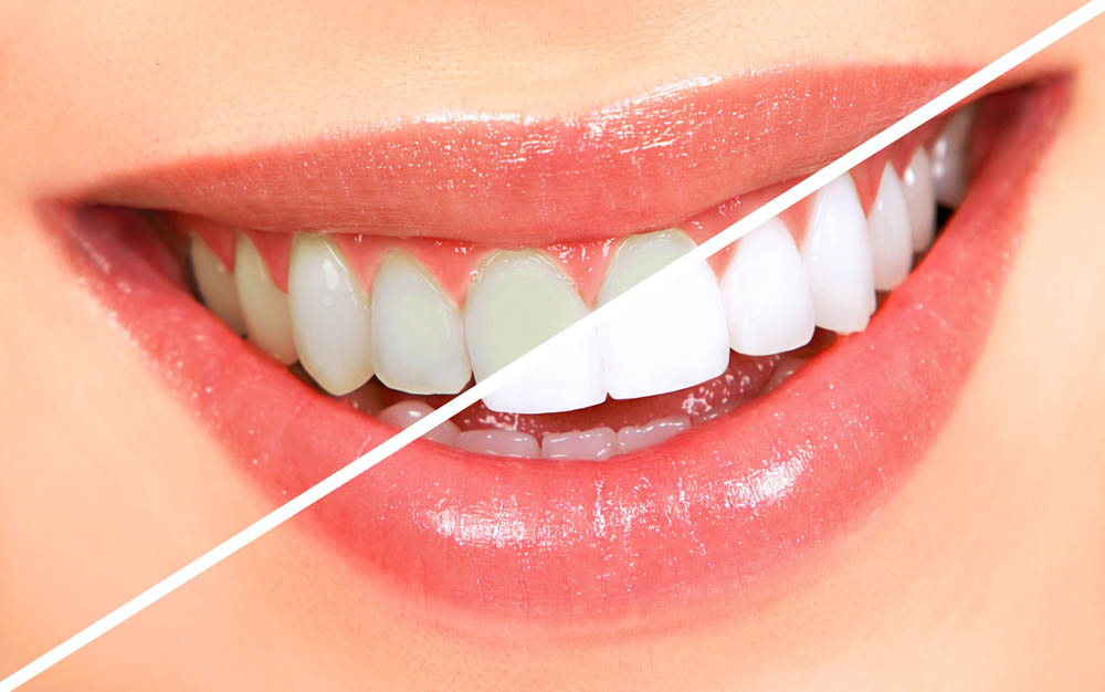 معجون شگفت انگیز برای سفید کردن دندانها