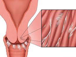پاورپوینت آشرمن یا چسبندگی رحمی و درمان آن