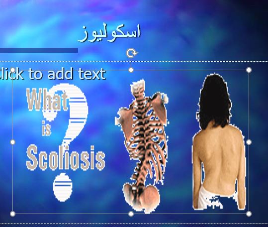 دانلود پاورپوینت در مورد اسكوليوز