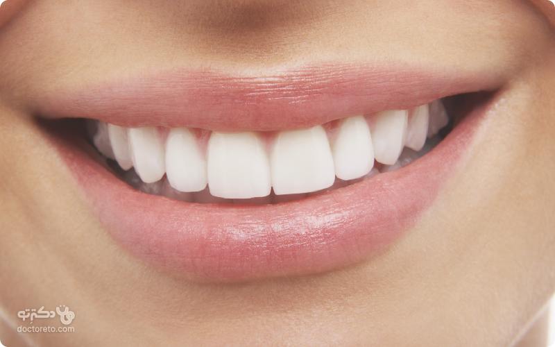 راهنمای جامع سفید کردن دندان