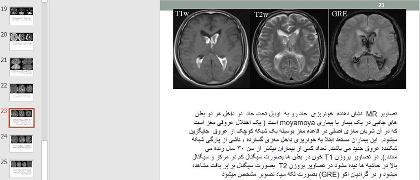 دانلود پاورپوینت ارزیابی خون ریزی های مغزی در MRI در 27 اسلاید