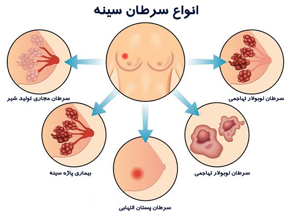 پاورپوینت و pdf "همه چیز درباره سرطان سینه" در 34 اسلاید