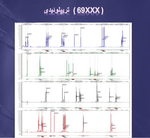 مطالعه ی اختلالات تعدادی کروموزومی در 640 مورد مطالعه با استفاده از روش QF-PCR در 11 اسلاید